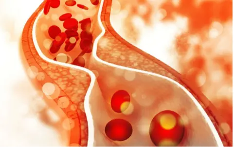 Cholesterol cao có nguy hiểm không? Những biến chứng nghiêm trọng bạn không nên chủ quan